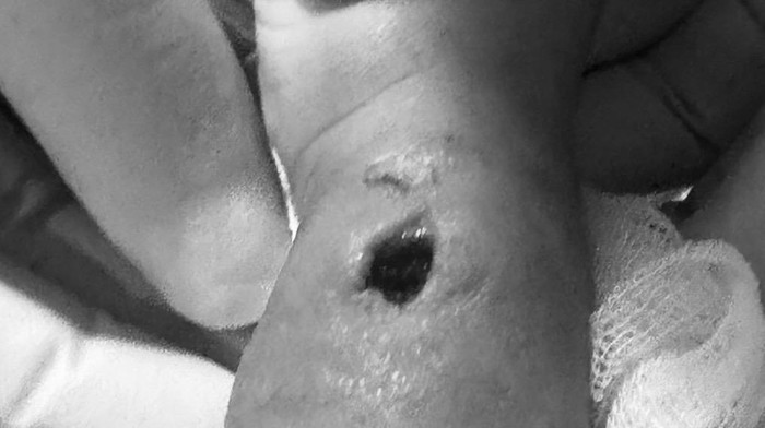 Ilustrasi tangan bayi bengkak usai tindakan infus di rumah sakit